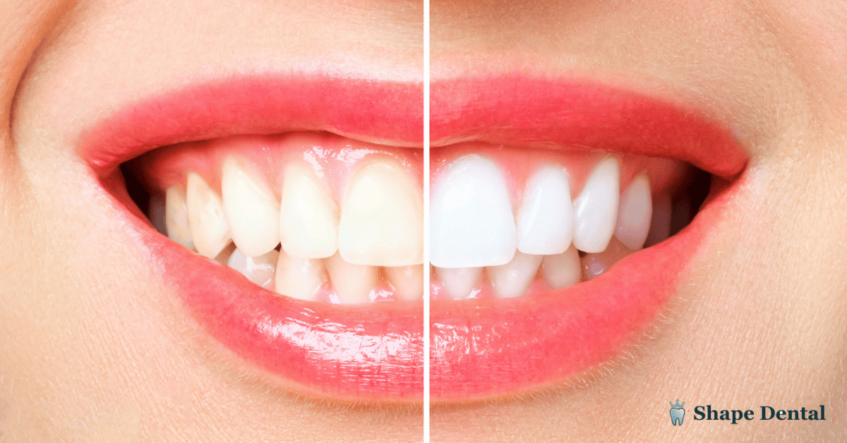 Can I Chew Gum After Wisdom Teeth Removal?