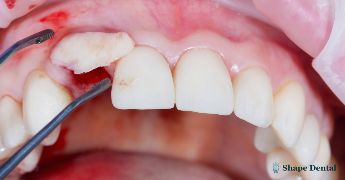 9 Warning Signs of a Failed Dental Bone Graft 2 Failed Dental Bone Graft