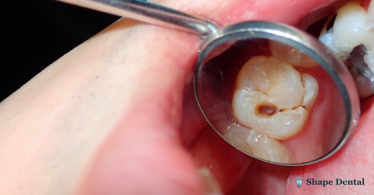 9 Warning Signs of a Failed Dental Bone Graft 1 Dental Bone