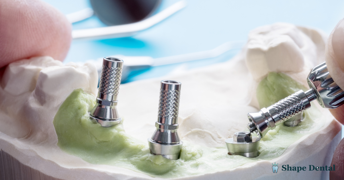All-on-4 Dental Implants