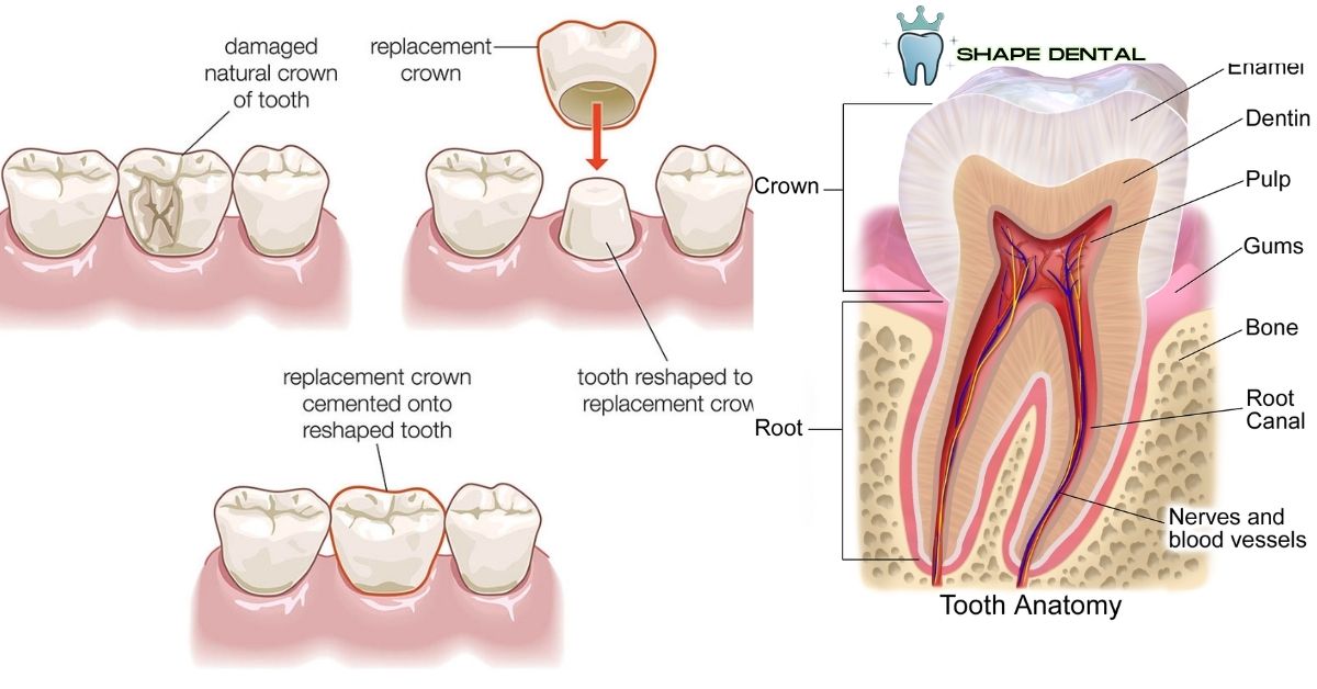 Dental crown structure showing restoration of damaged tooth